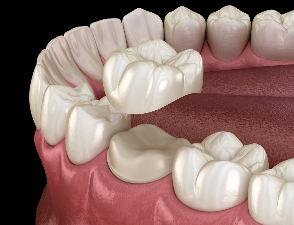Preparated molar tooth for dental crown placement. Medically accurate 3D illustration