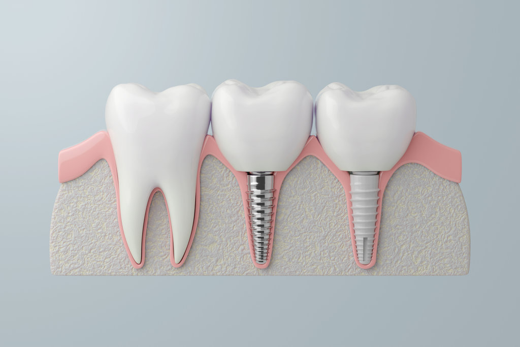 Comparison of Titanium and Zirconia Dental Implant Types. 3D Rendering
