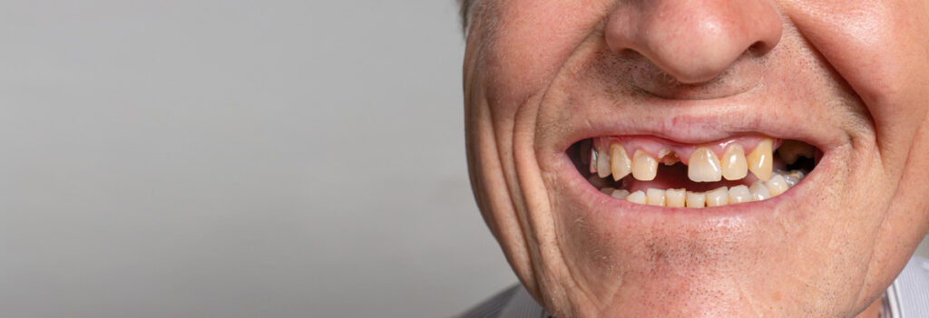 The toothless smile of an old European man on a gray background. Dentistry for pensioners, happy old age, dentist installing dentures